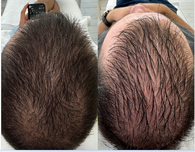 Tri tretmana egzozomima za rast kose